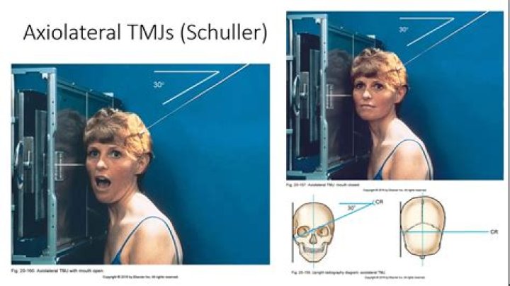 Axiolateral (schuller method) - TMJ Quiz