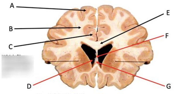 Brain cross section(USMLE) Quiz